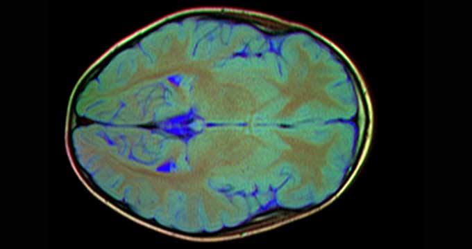 sarcina neurostiinte